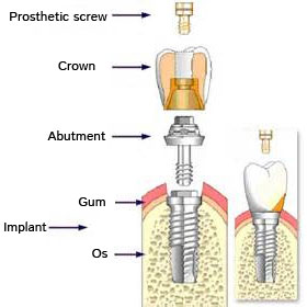 implantdentaire en