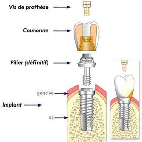 implantdentaire